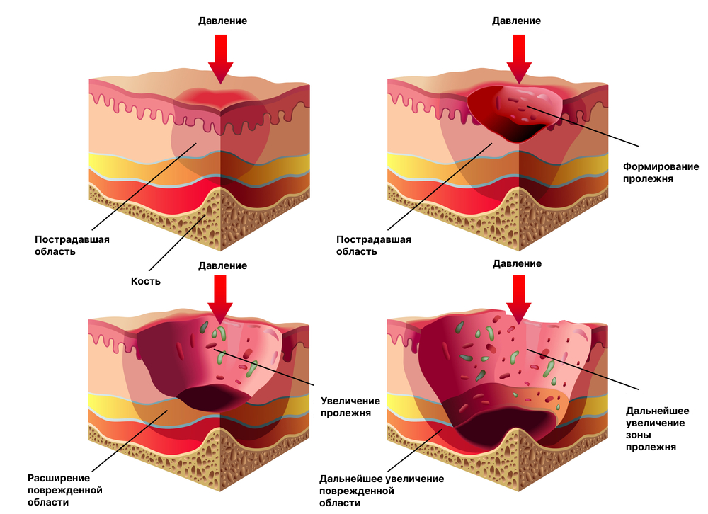как избежать появления пролежней