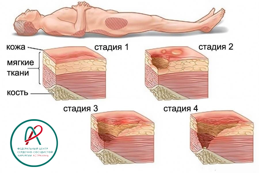 Профилактика и лечение пролежней